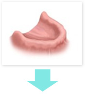 インプラント治療　1歯欠損の場合