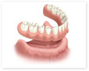 インプラント治療　1歯欠損の場合
